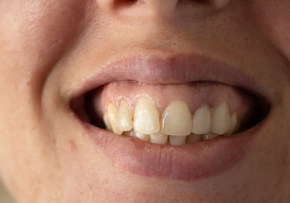 Orthodontic treatments for shifted teeth