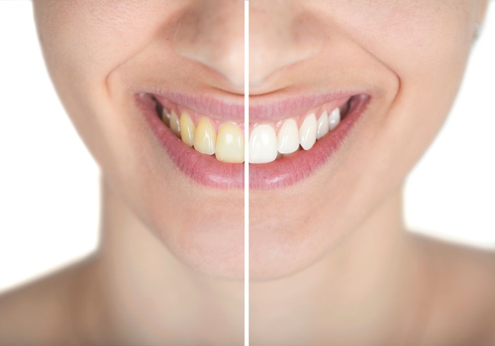 Overview of Dental Bleaching Methods