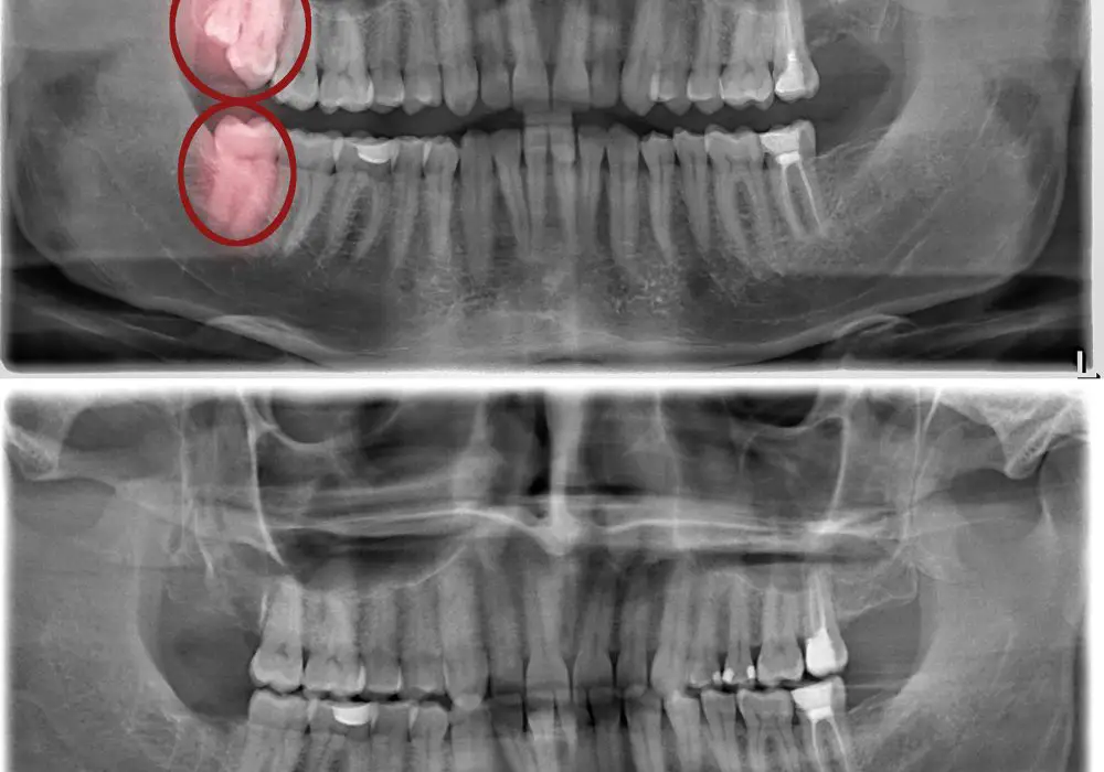 Possible Postoperative Complications