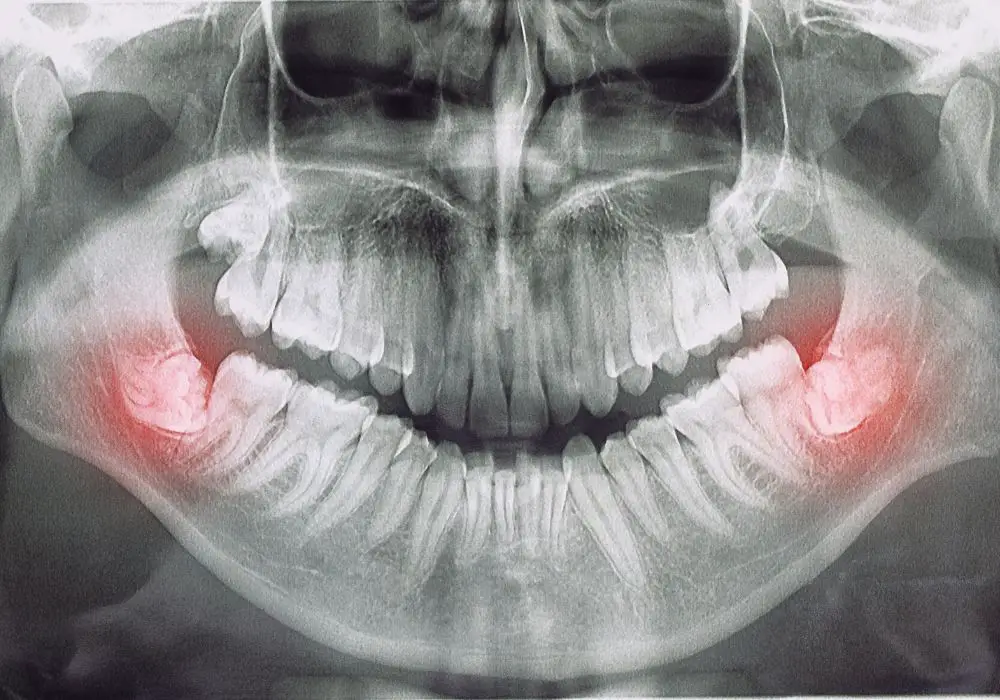 Post-op care 48 hours after wisdom teeth removal