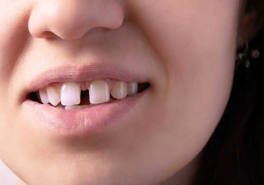 Potential Problems Caused by Gaps Between Teeth