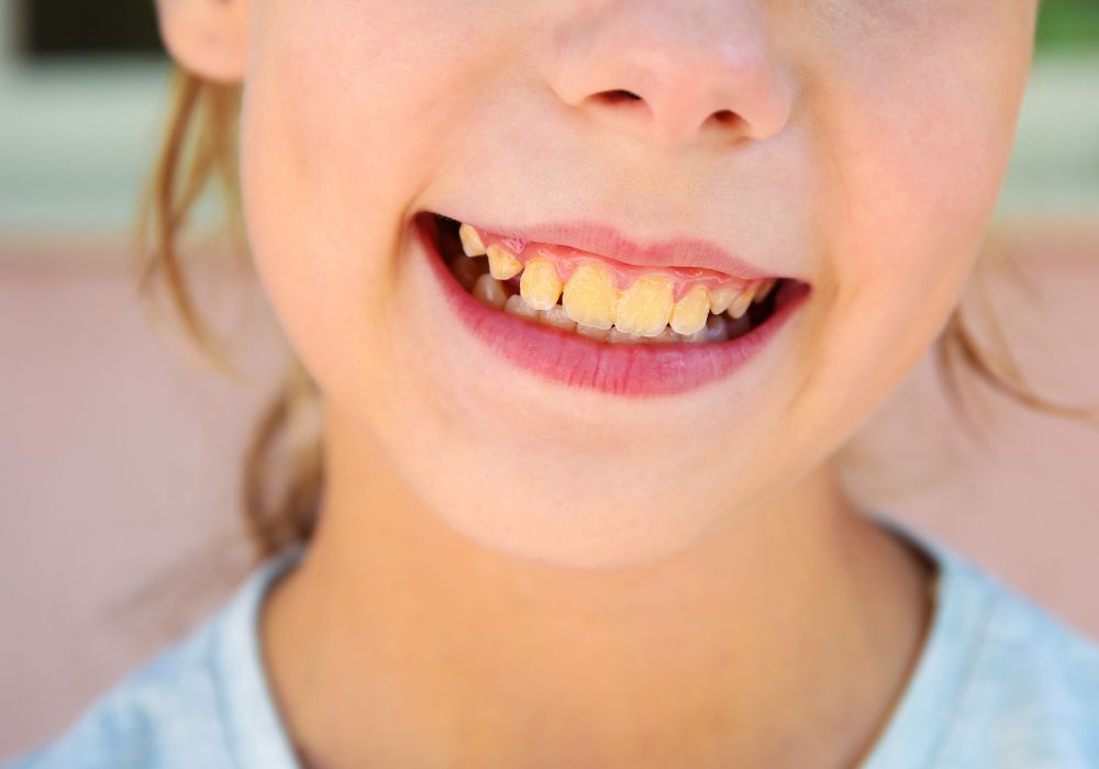 Preventing Yellow Teeth