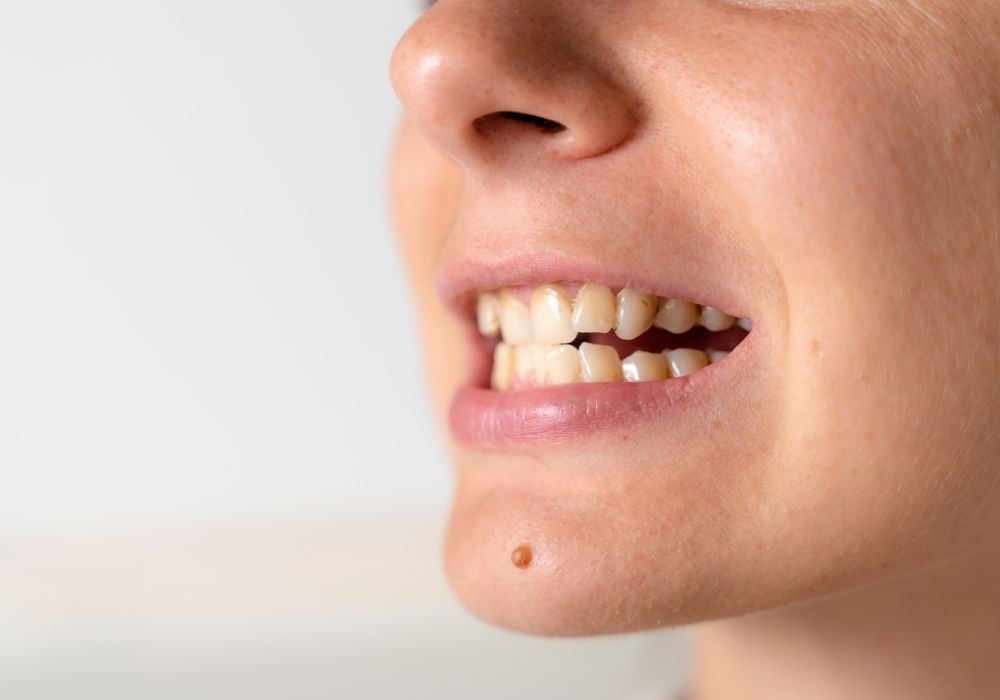 Preventing and Removing Coffee Stains on Teeth