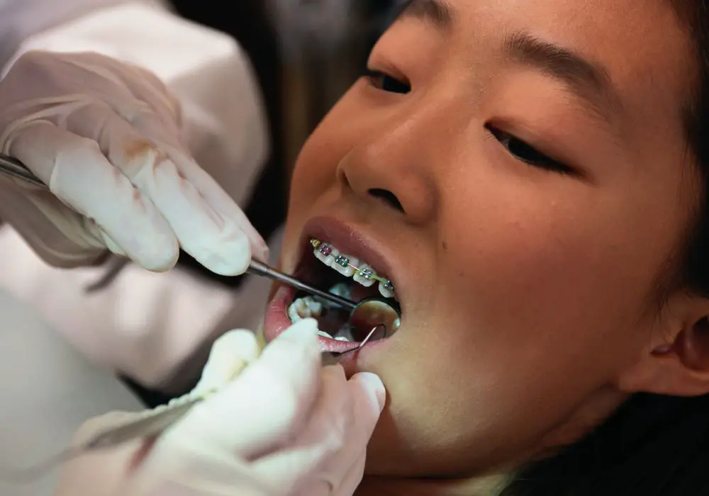 Process of Getting Braces with Missing Teeth