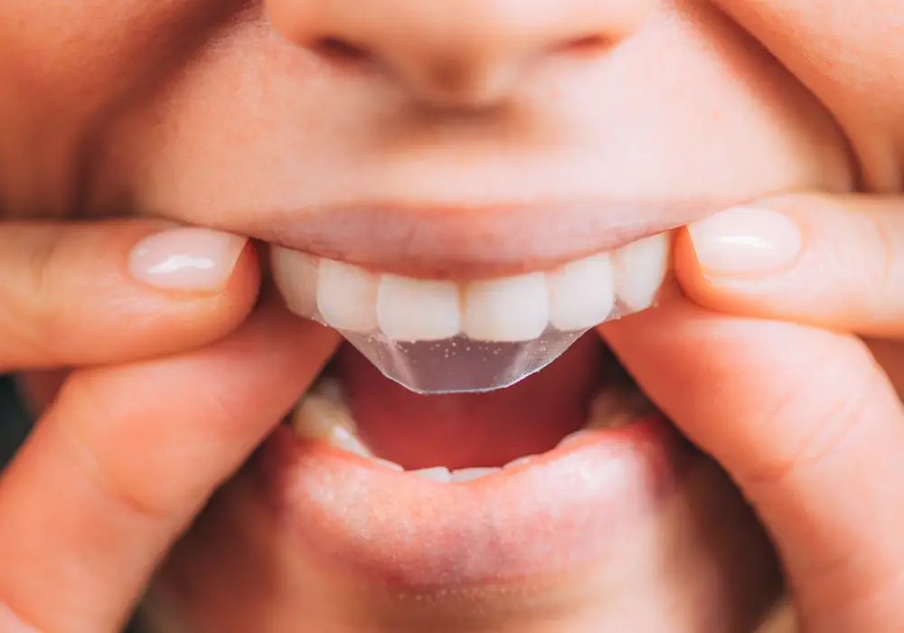 Professional Teeth Whitening Methods