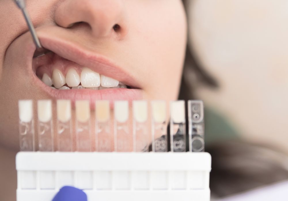 Professional Teeth Whitening Options