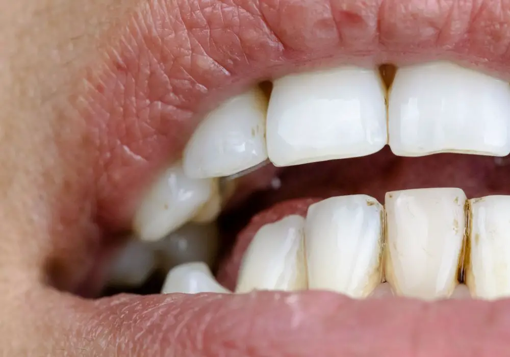 Professional Teeth Whitening Treatments