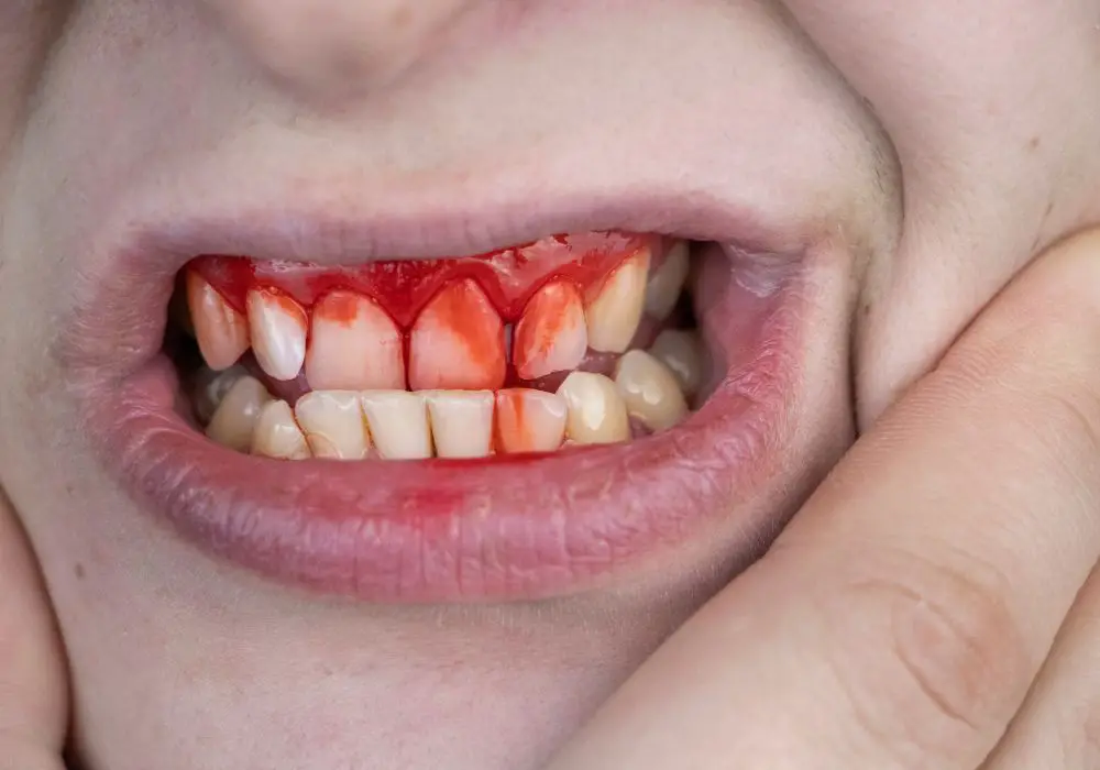 Professional Treatment Options for Bleeding Teeth