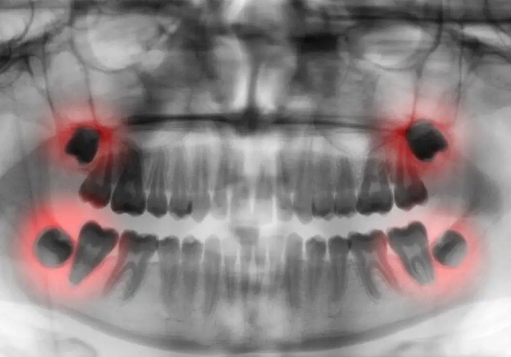 Professional realignment options to consider if teeth shift