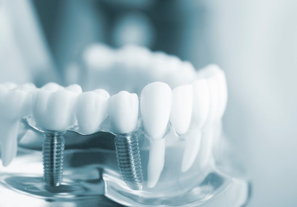 Pros and cons of 1 implant for 2 teeth