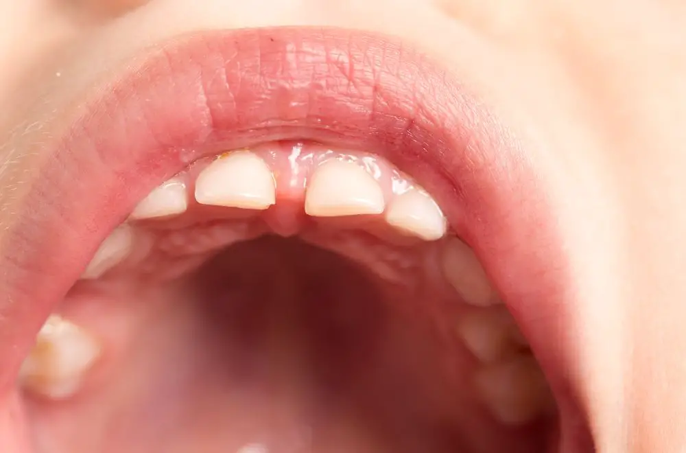 Reasons for Having 15 Bottom Teeth