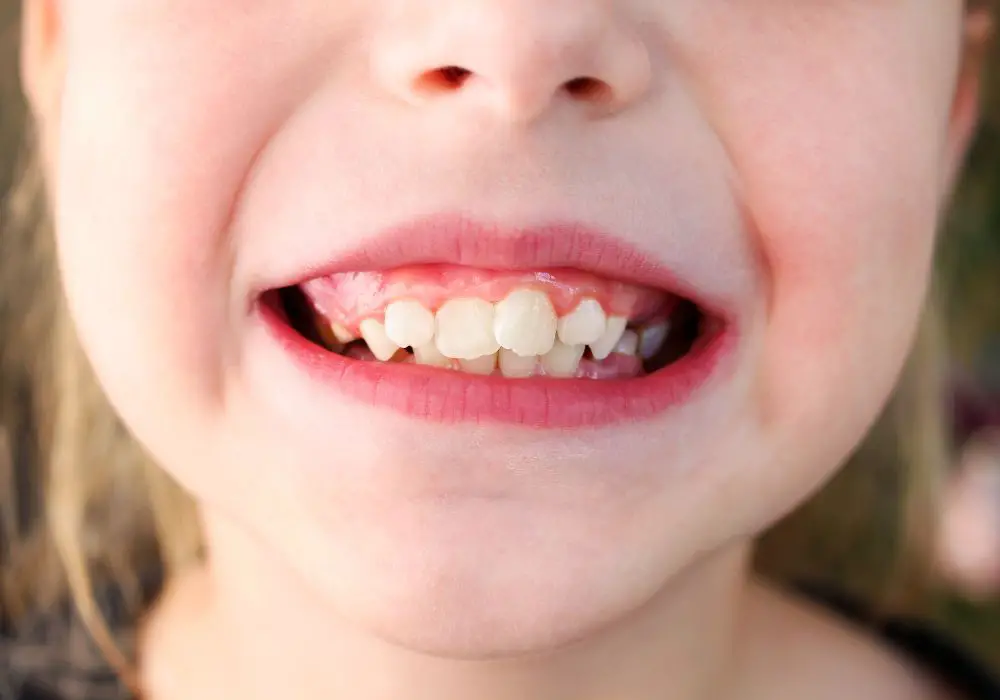 Reasons for Yellow Teeth in 8-Year-Olds