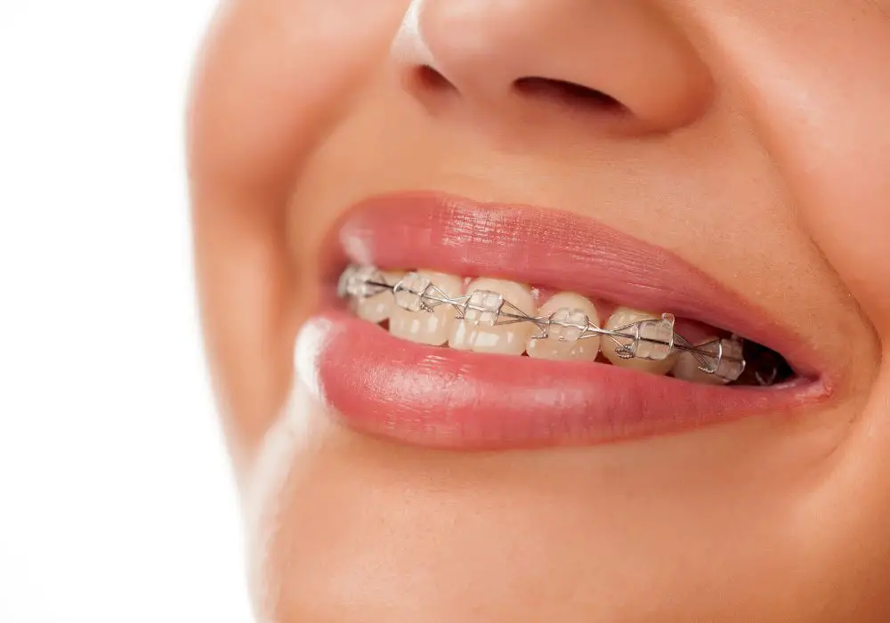 Reasons for tooth discoloration with braces