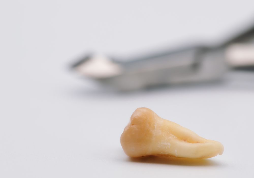 Recovery Tips After Wisdom Tooth Removal