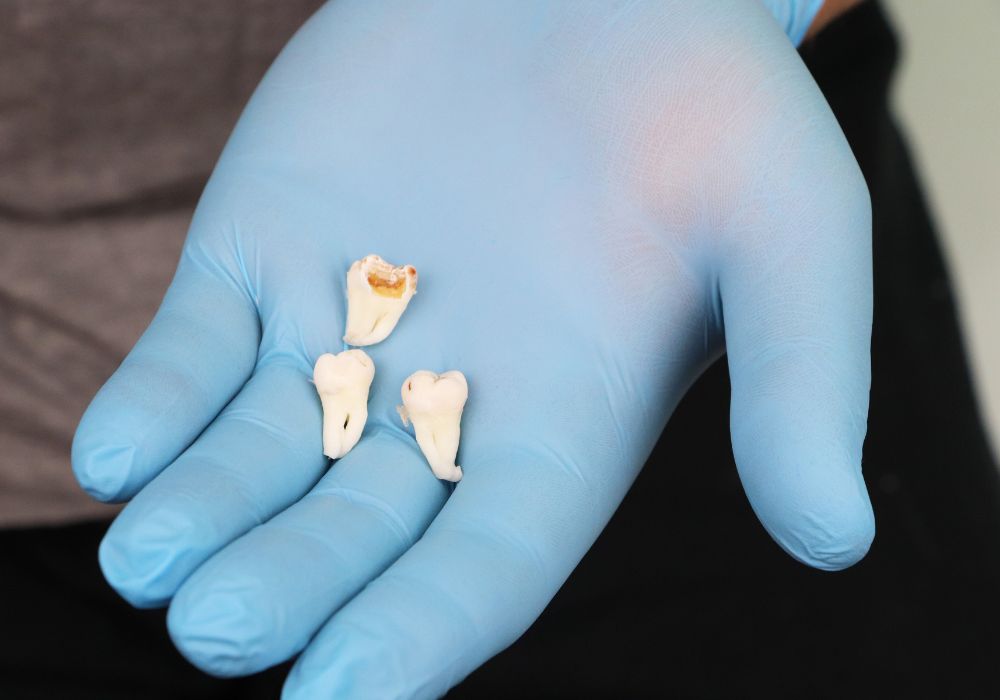 Risks and complications associated with wisdom teeth removal