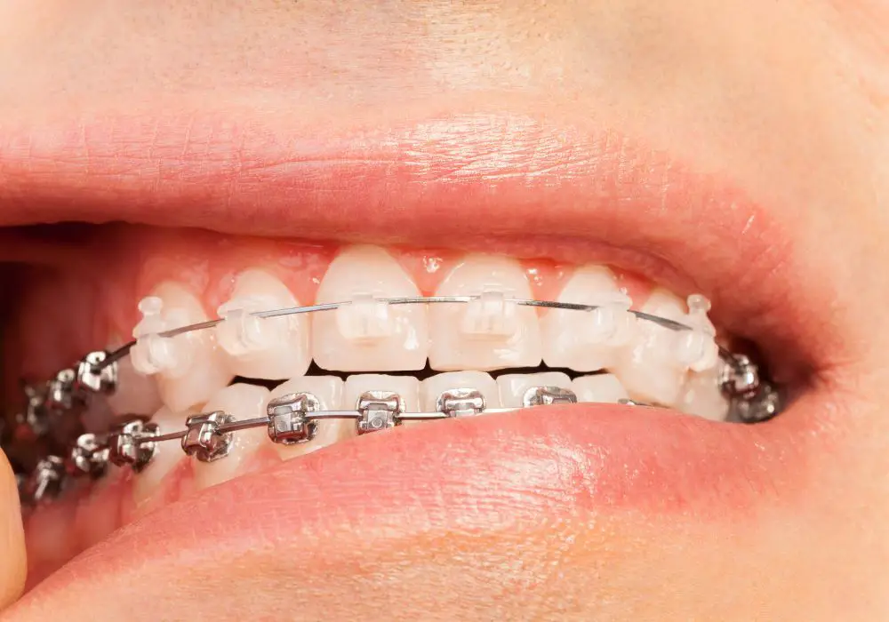 Risks of Orthodontic Tooth Filing