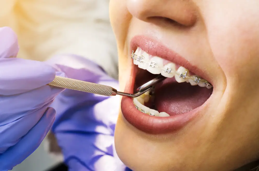 SameDay Braces After Tooth Extraction Is it Possible?