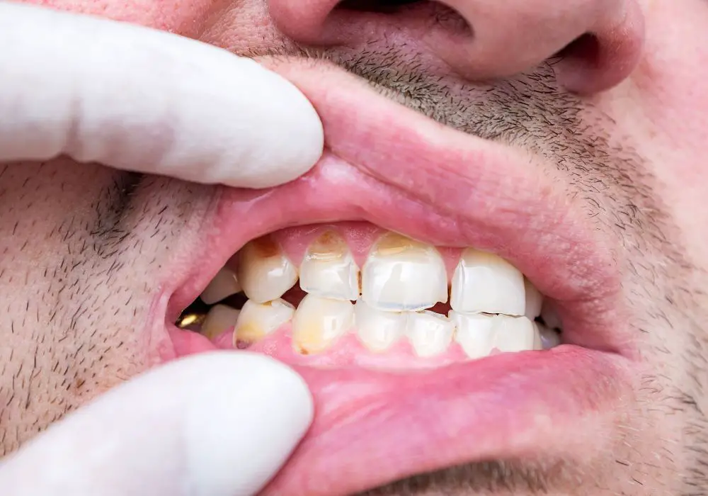 Seeking Treatment for a Chipped Tooth