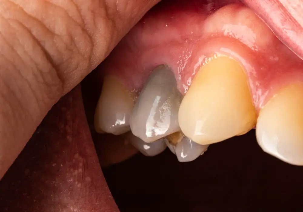 Signs It's Time to Treat a Dead Tooth