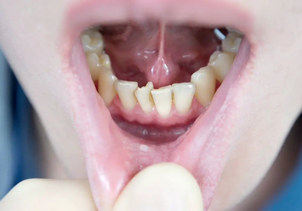Signs and Symptoms Associated with Crowded Teeth