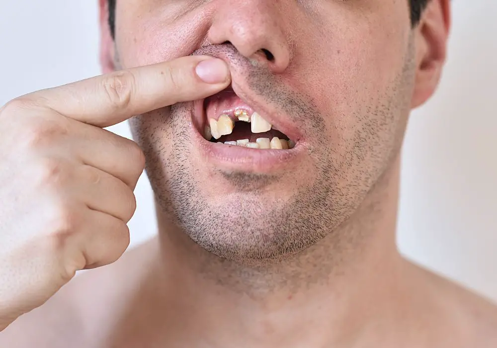 Signs and symptoms of broken teeth