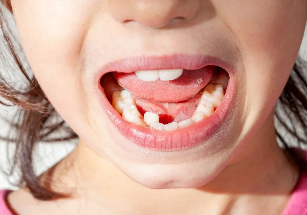 Signs and symptoms of misaligned teeth