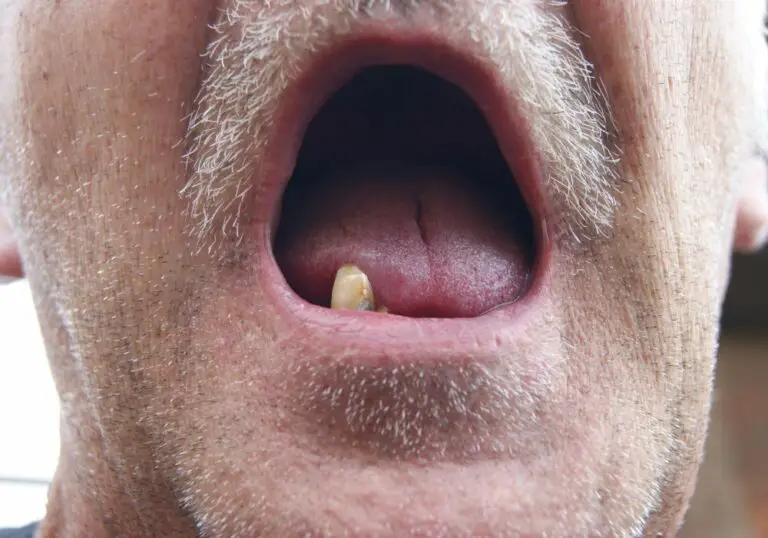 What Kind Of Food Can You Eat With No Teeth? (Soft Foods)