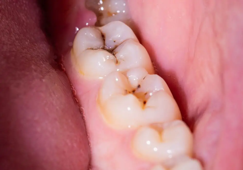 Step-by-step instructions on how to temporarily fill a cavity at home