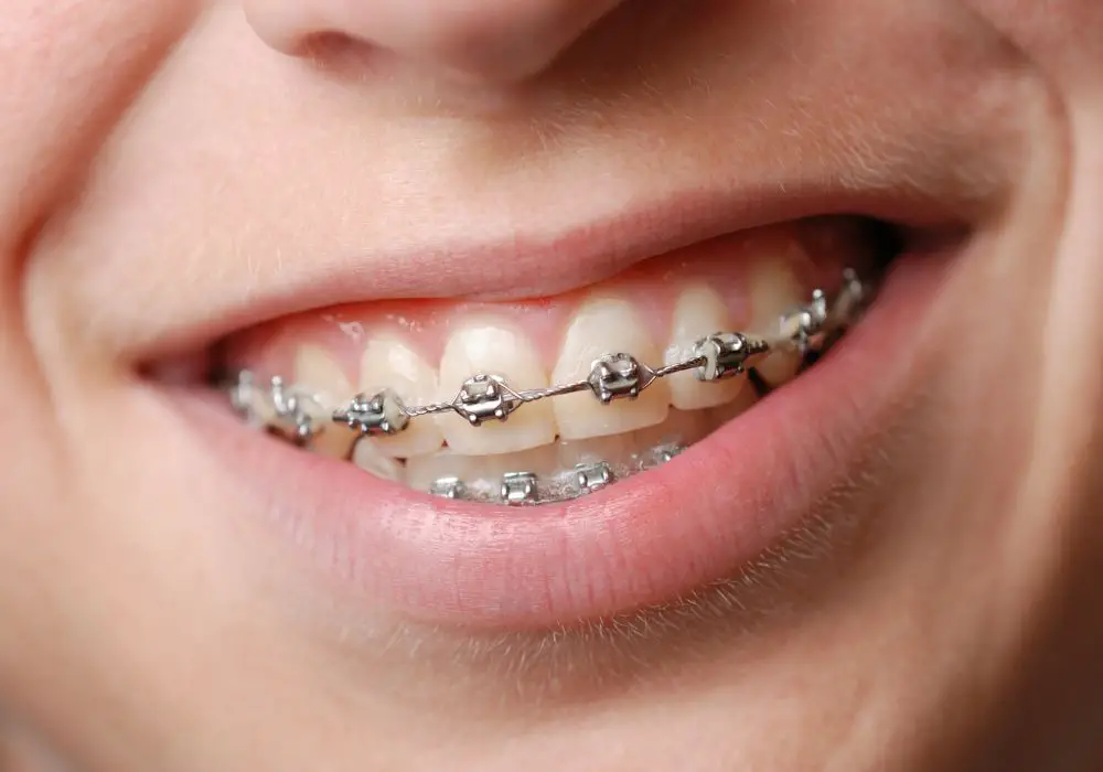 Strategies to Minimize Braces Pain