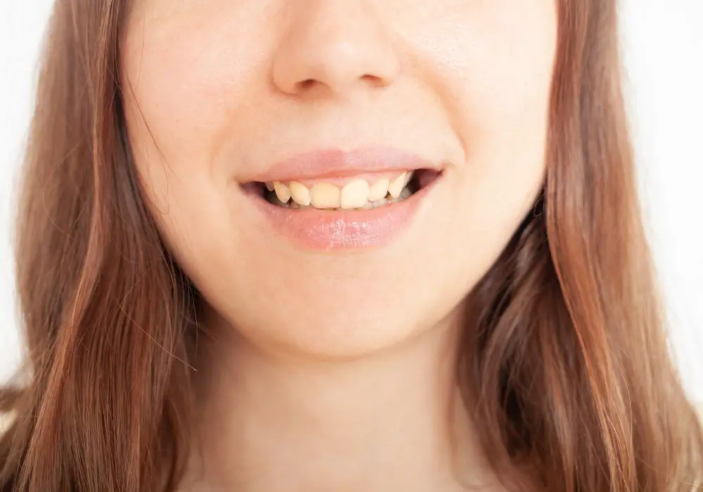 Symptoms of Iron Deficiency Related Teeth Discoloration