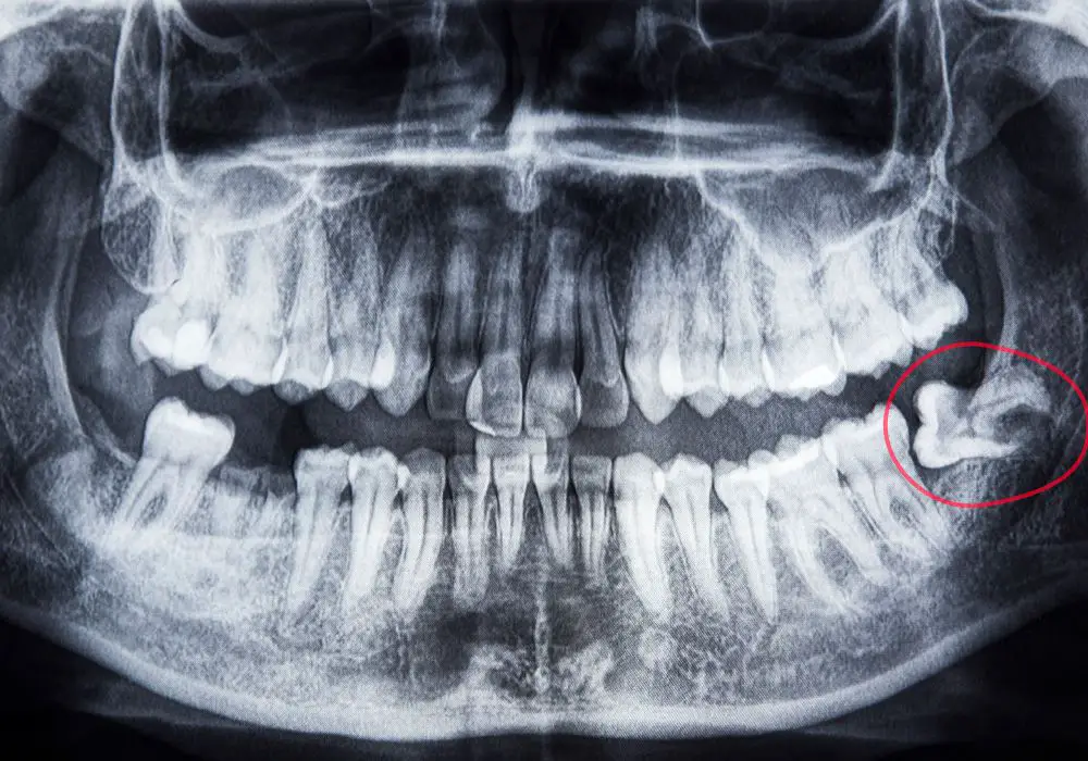 Symptoms of impacted wisdom teeth