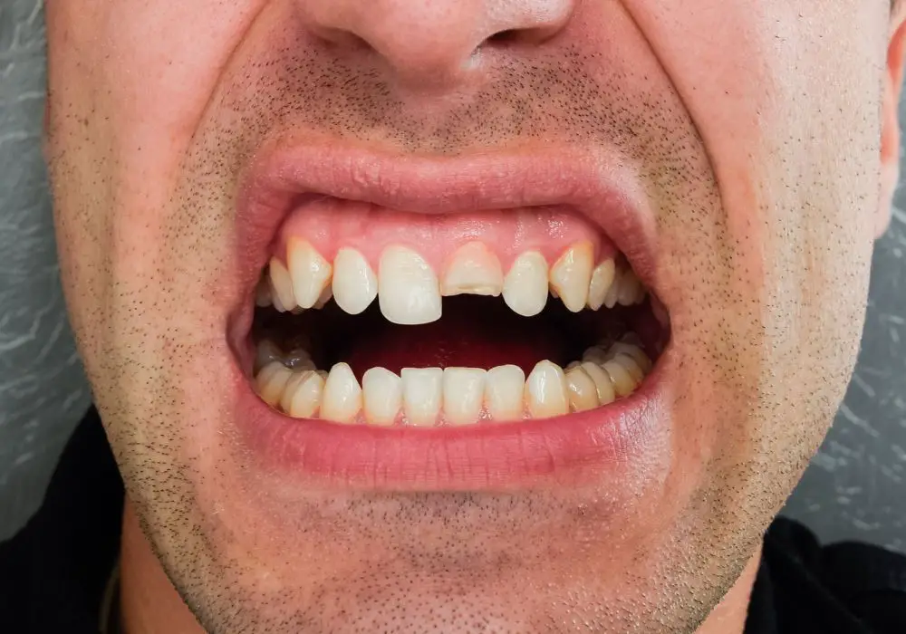 Table comparing bonding vs other front tooth repair options