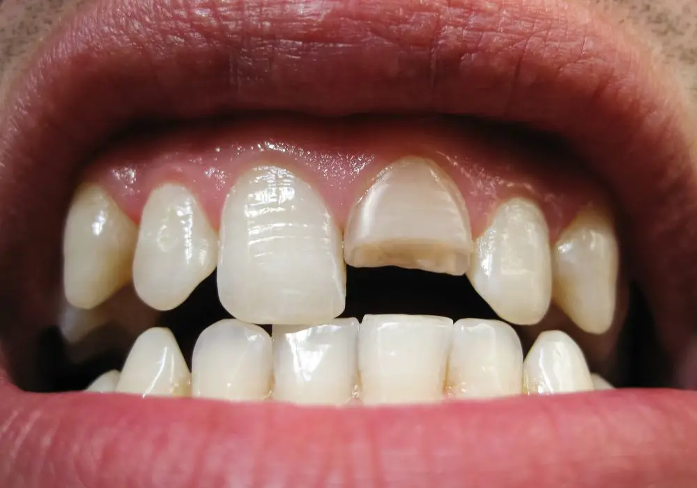 Temporary treatment for cracked or broken teeth