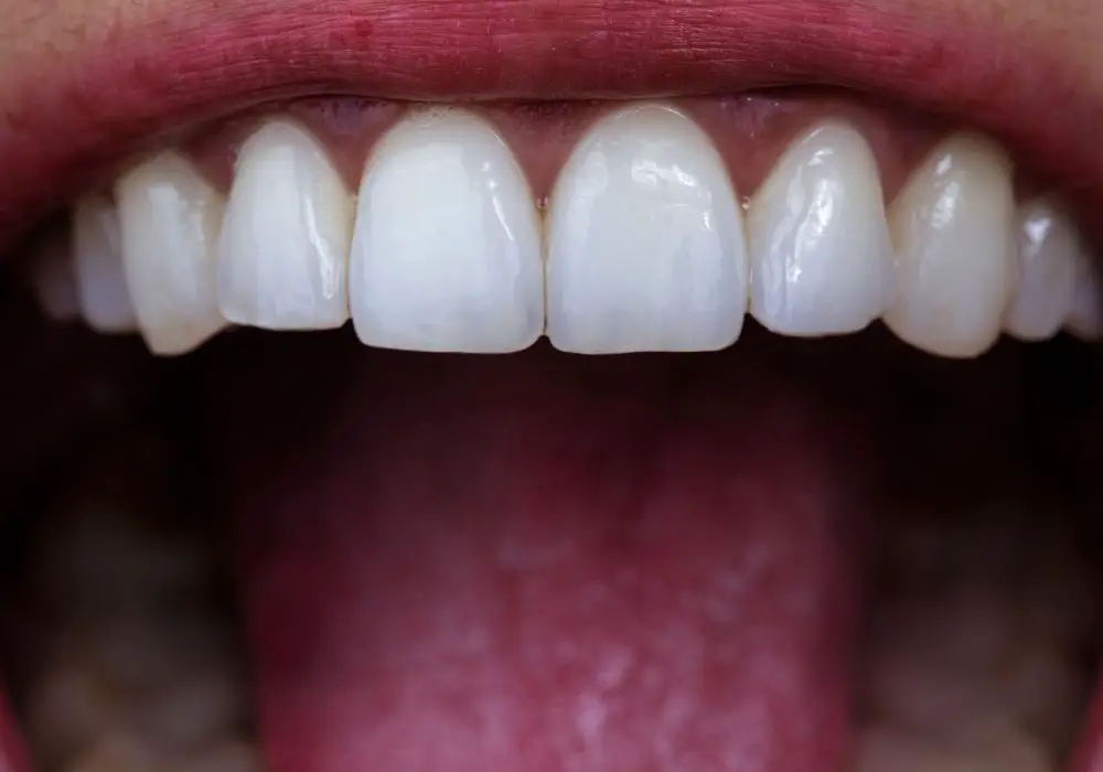 The Importance of Proper Dental Alignment