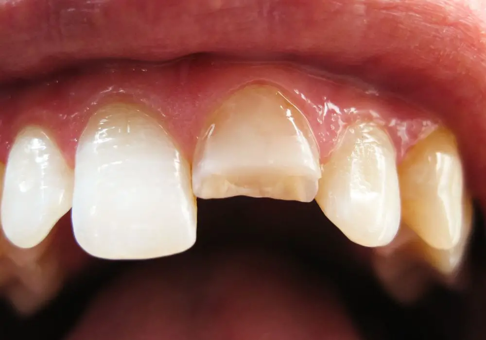 The benefits of repairing damaged teeth