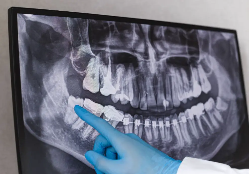 The risks and issues with wisdom teeth in modern times