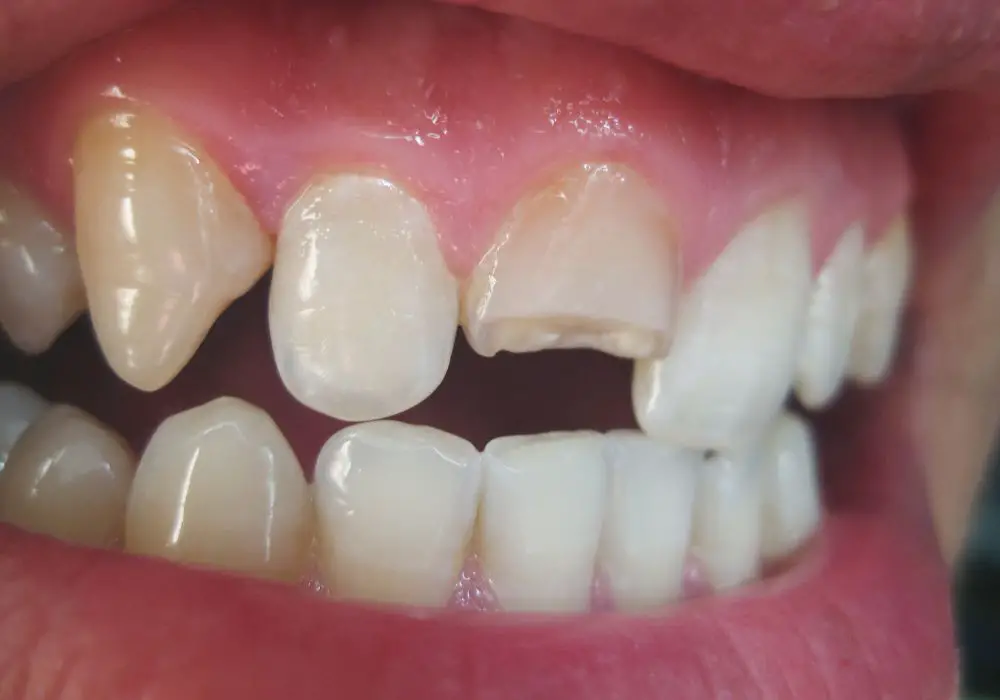 The tooth bonding procedure step-by-step