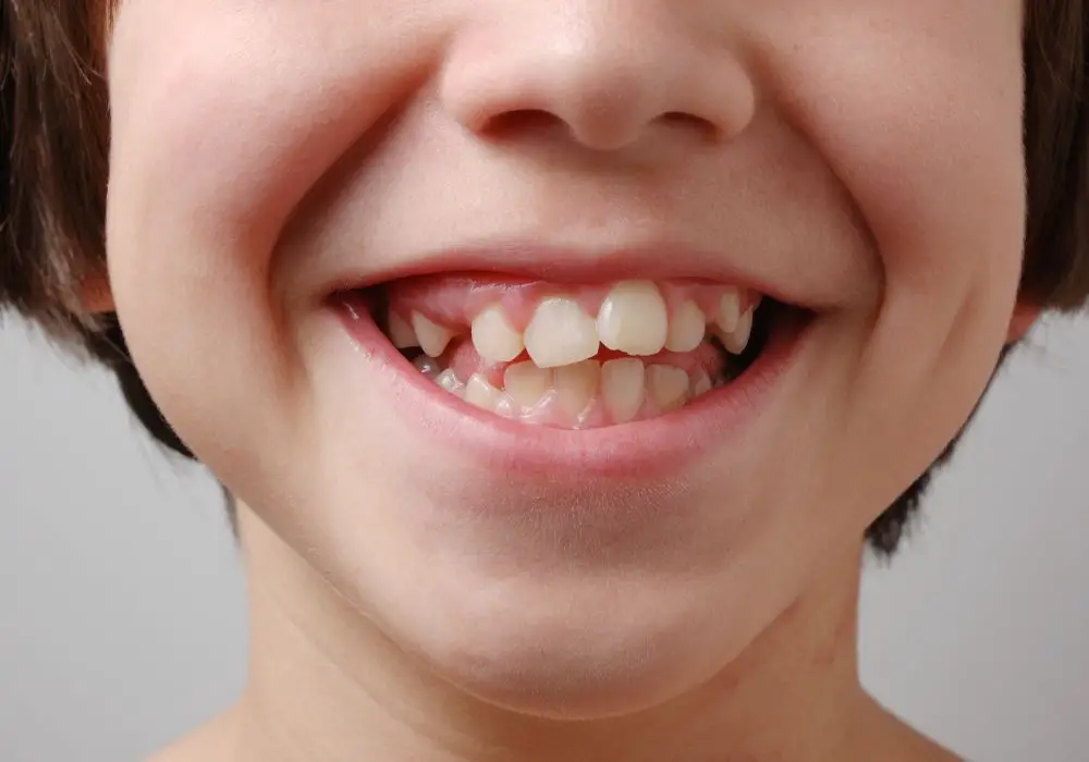 Theories explaining crooked teeth evolution