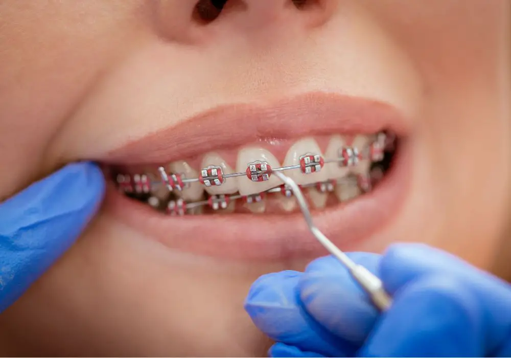 Tips for faster teeth shifting with braces or aligners