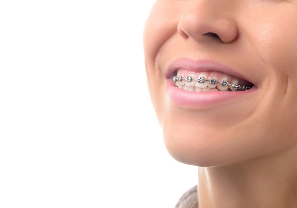 Tips for safe whitening with braces