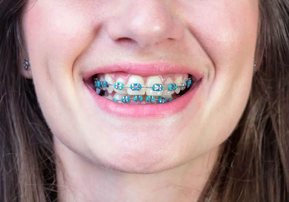 Tips to help close a gap with braces