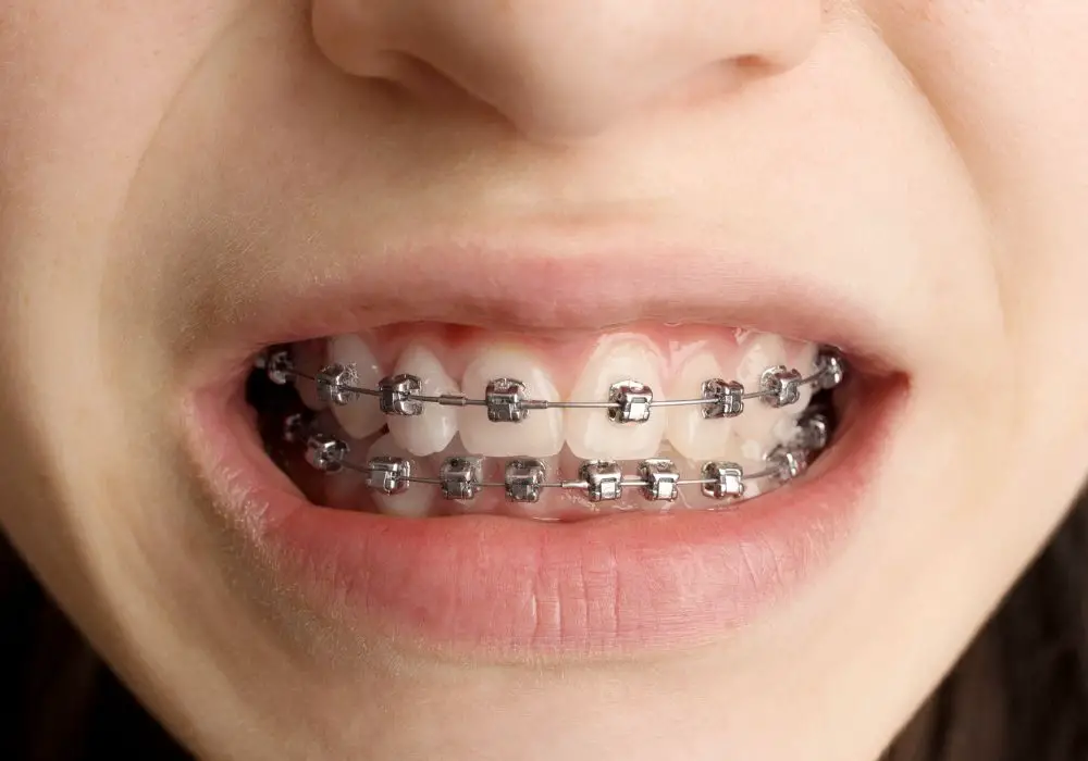 Tips to reduce teeth popping with braces