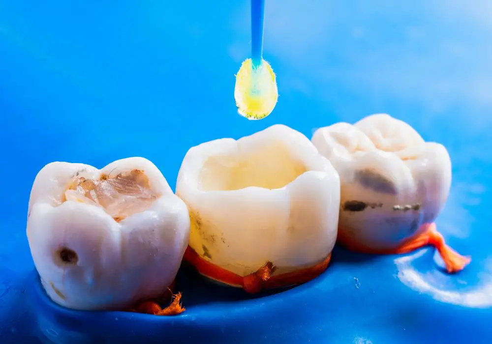 Tooth-Colored Fillings