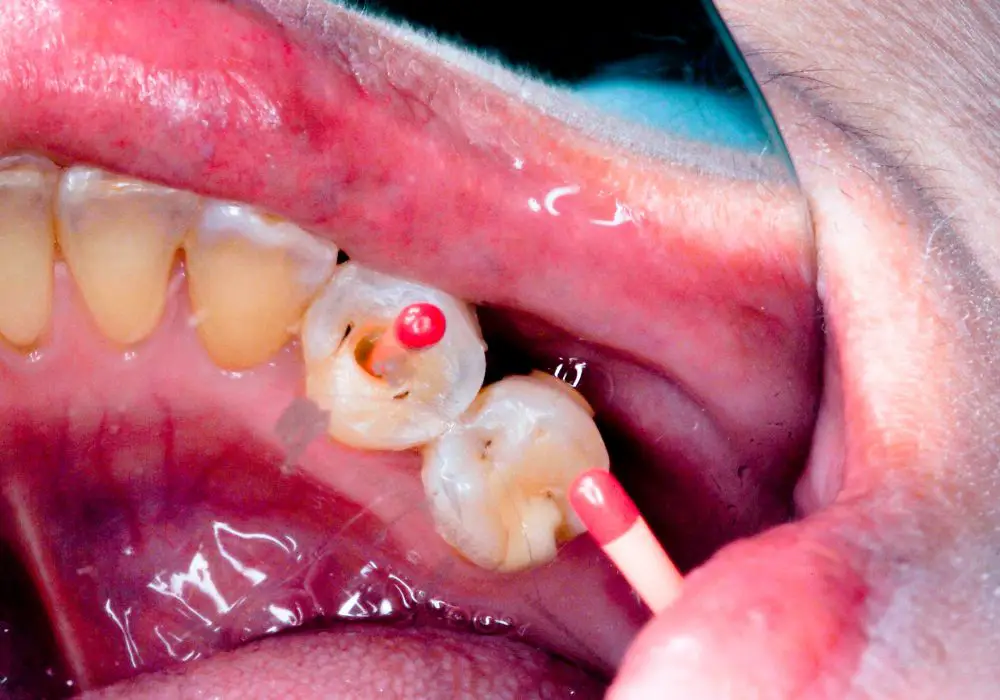 Tooth Difficulty Ranking for Root Canals