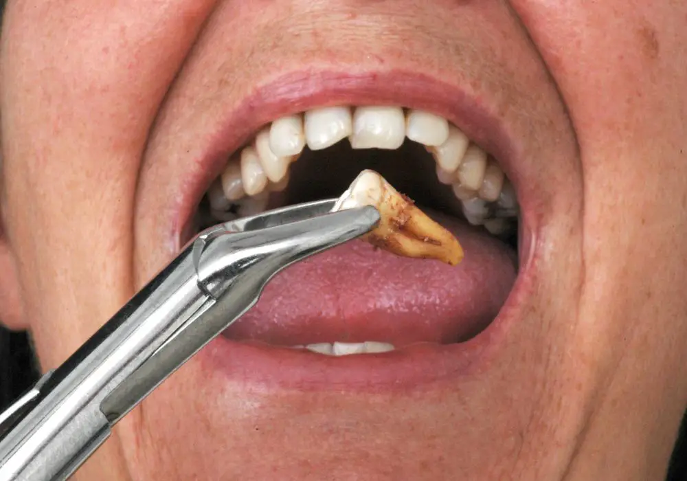 Tooth Extraction