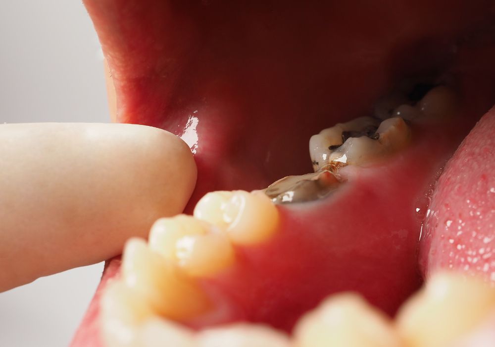 Treating an infected tooth