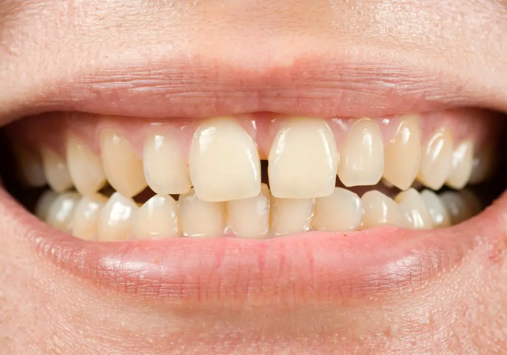 Treatment Options for Yellow Teeth