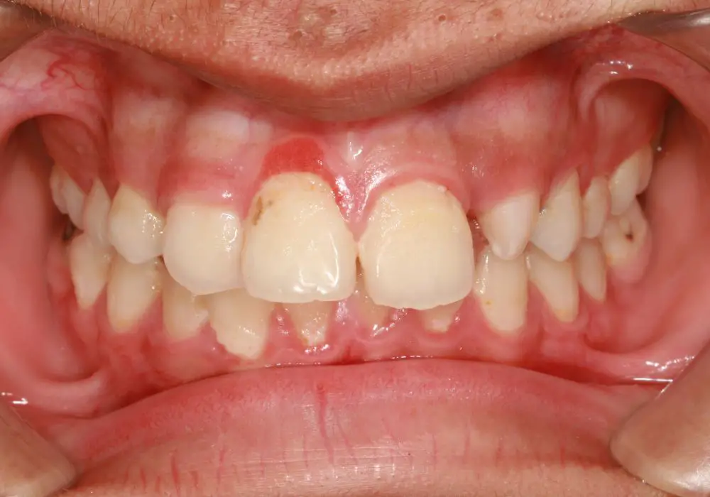 Treatment options for gum disease