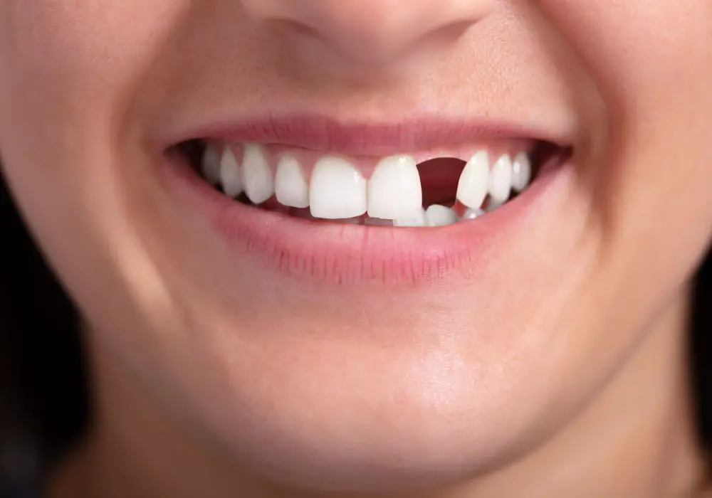 Treatments for Cracked, Chipped, or Fractured Teeth