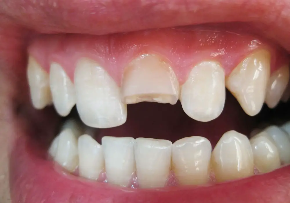 Types of Broken Teeth